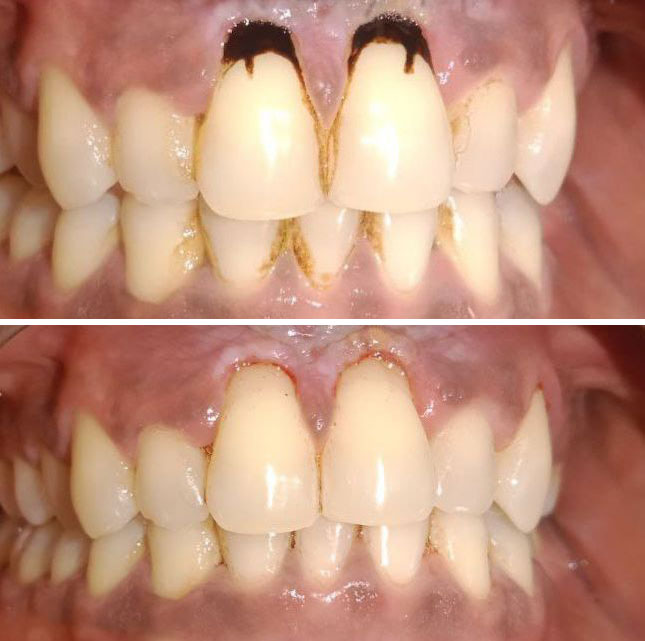Teeth-cleaning Tooth Cleaning