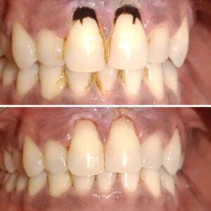 Tooth Cleaning
