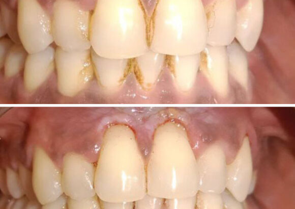 Tooth Cleaning