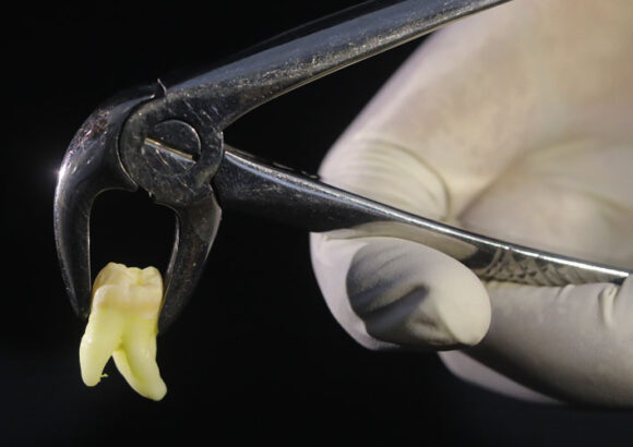 Tooth Removal