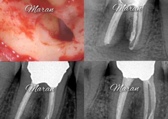 Molar Surgery
