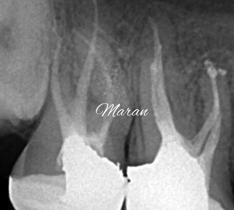 Root Canal Treatment