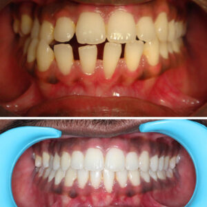 Teeth Alignment. The Best Specialists