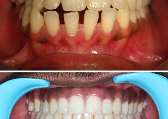 Teeth Alignment
