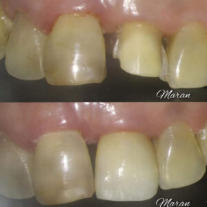 Veneers
