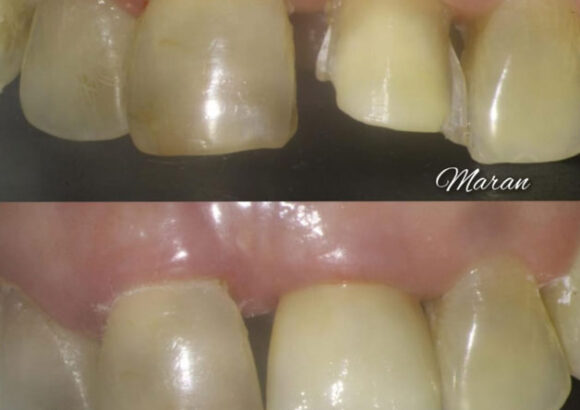 Veneers